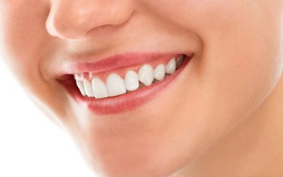 Blanqueamiento dental en Murcia: guía completa para una sonrisa radiante