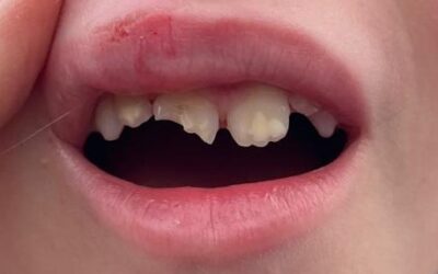 Traumatismo dental en niños: Cómo actuar ante un diente roto