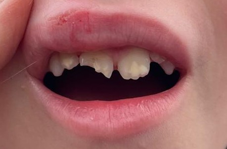 Traumatismo dental en niños: Cómo actuar ante un diente roto