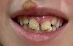 Traumatismo dental en niños