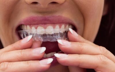 Cómo cuidar tu ortodoncia invisible: Guía completa